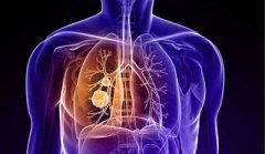 肺癌诊治有了“上海标准”，多项研究成果提升患者生存率